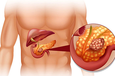 Pancreas Disease