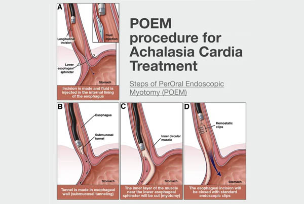 Advanced Endoscopic Procedures